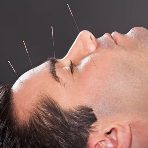 Facial acupuncture nyc