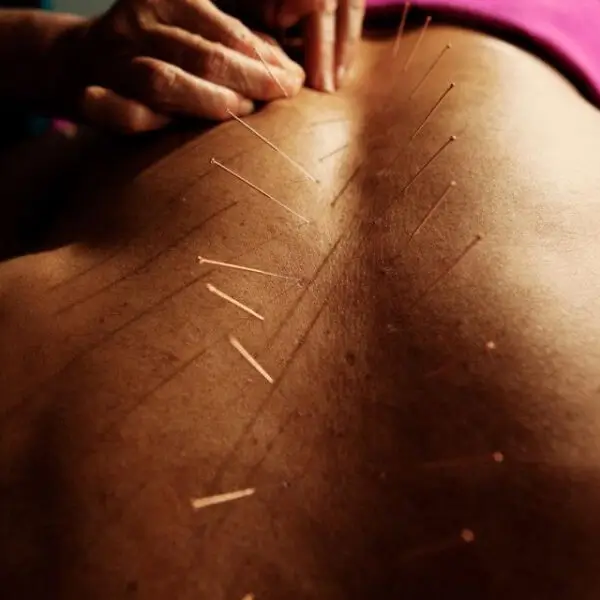 Acupuncture near me, Fort Montgomery, NY