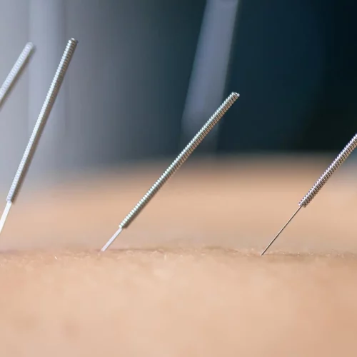acupuncture for back pain near me