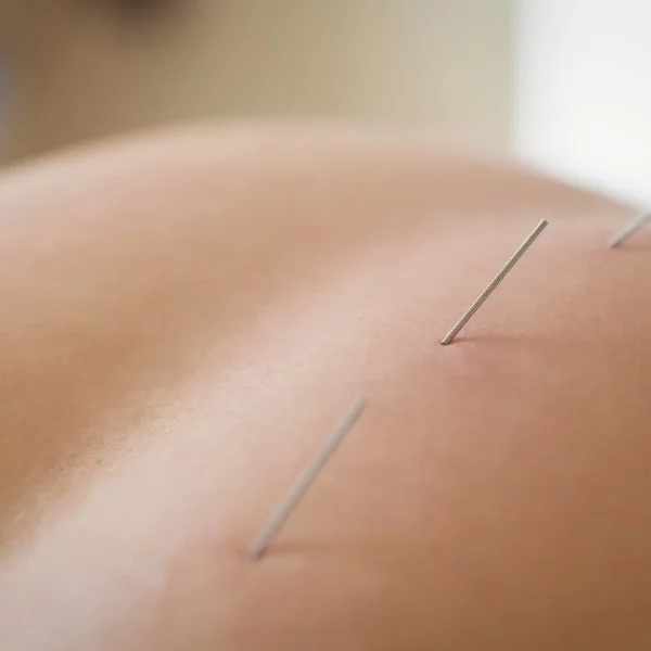 acupuncture for weight loss near me